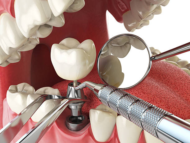 Best Knocked-Out Tooth Emergency  in Burien, WA